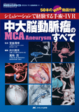中大脳動脈瘤（MCA Aneurysm）のすべて