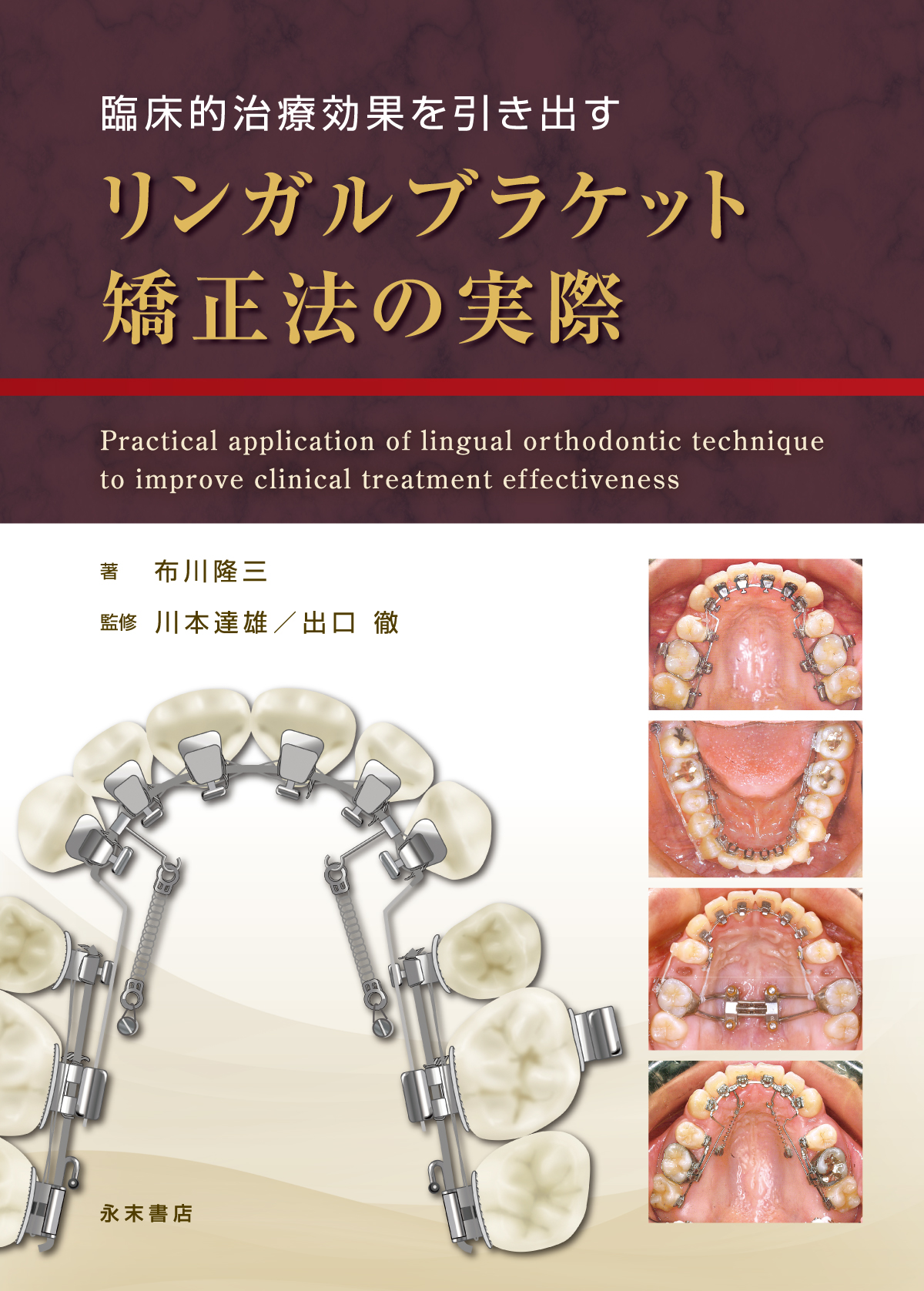 臨床的治療効果を引き出す　リンガルブラケット矯正法の実際