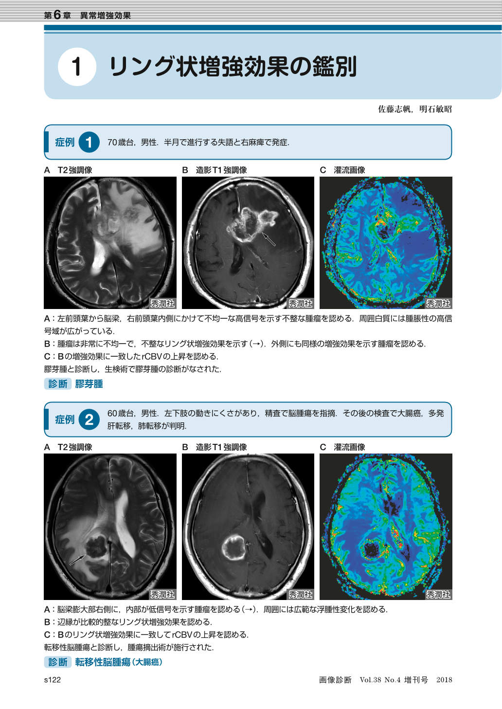 第6章 異常増強効果 1 リング状増強効果の鑑別 画像診断 38巻4号 医書 Jp