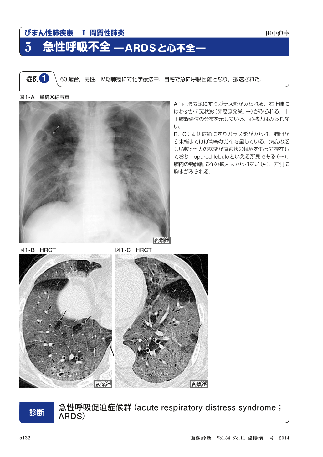 びまん性肺疾患 間質性肺炎 急性呼吸不全 ARDSと心不全 (画像診断 34巻 