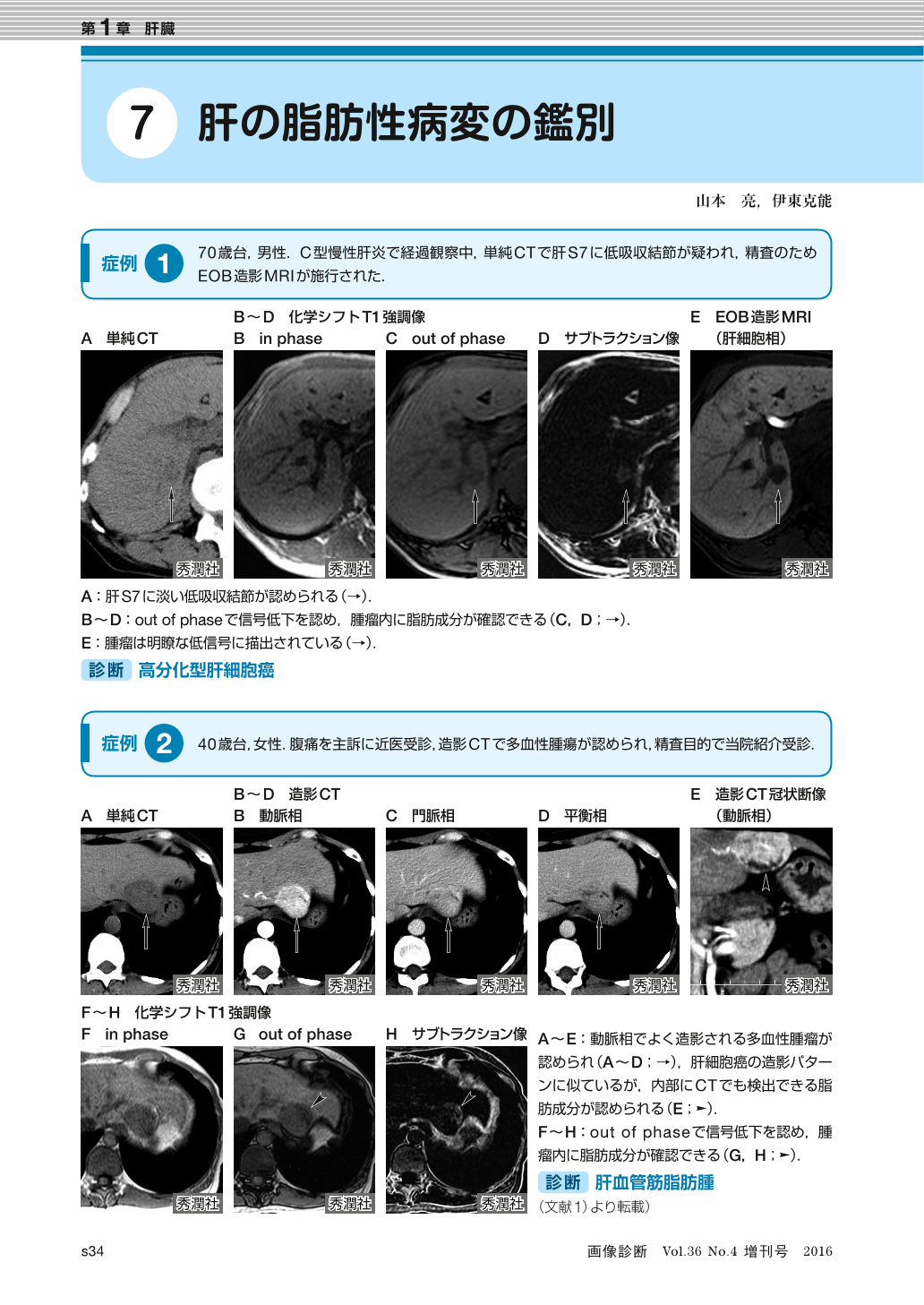 第1章 肝臓 −肝の脂肪性病変の鑑別 (画像診断 36巻4号) | 医書.jp