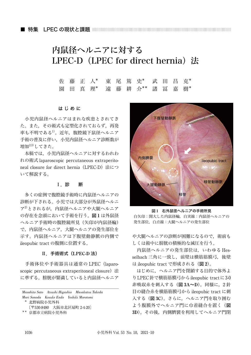 内鼠径ヘルニアに対するLPEC-D(LPEC for direct hernia)法 (小児外科 