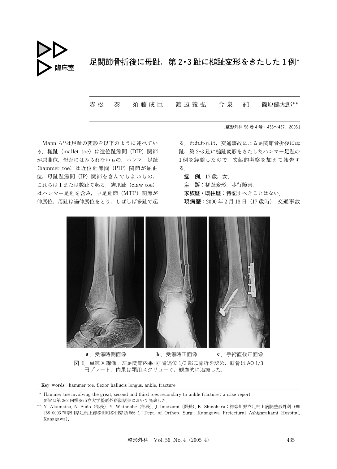 足関節骨折後に母趾 第2 3趾に槌趾変形をきたした1例 臨床雑誌整形外科 56巻4号 医書 Jp
