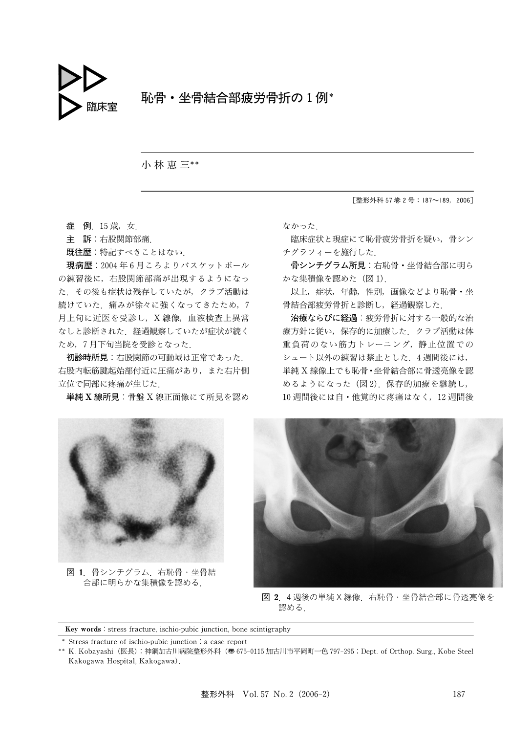 恥骨 坐骨結合部疲労骨折の1例 臨床雑誌整形外科 57巻2号 医書 Jp