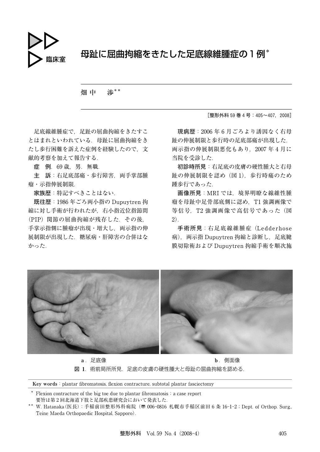母趾に屈曲拘縮をきたした足底線維腫症の1例 臨床雑誌整形外科 59巻4号 医書 Jp