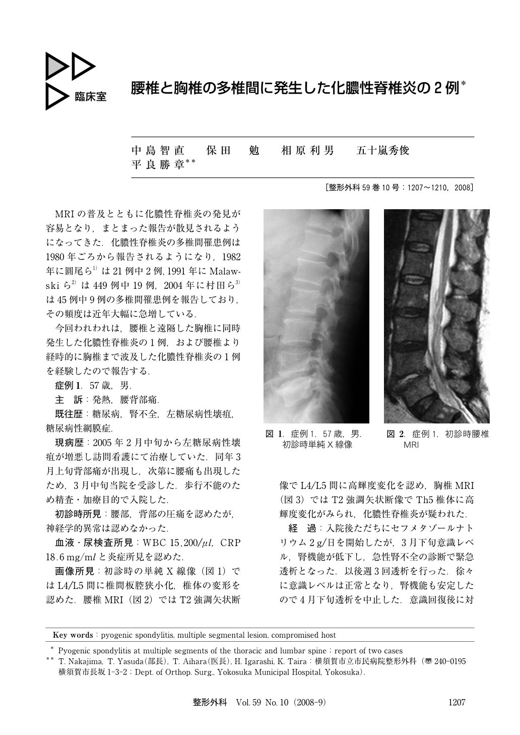 腰椎と胸椎の多椎間に発生した化膿性脊椎炎の2例 (臨床雑誌整形外科 59 