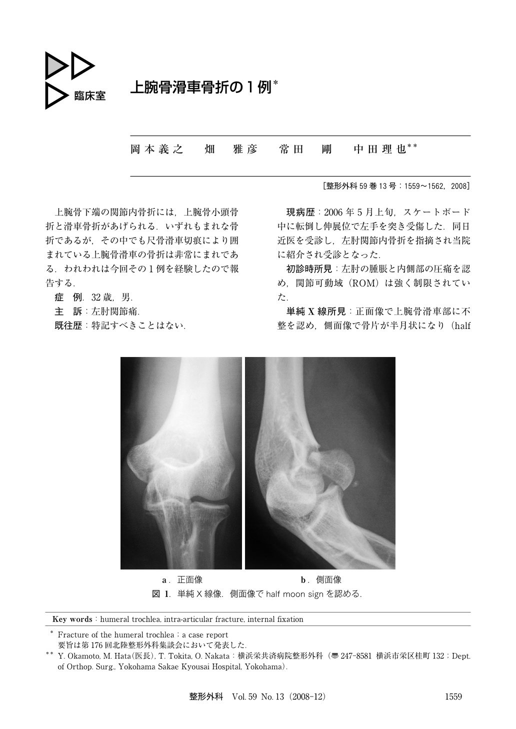 上腕骨滑車骨折の1例 臨床雑誌整形外科 59巻13号 医書 Jp