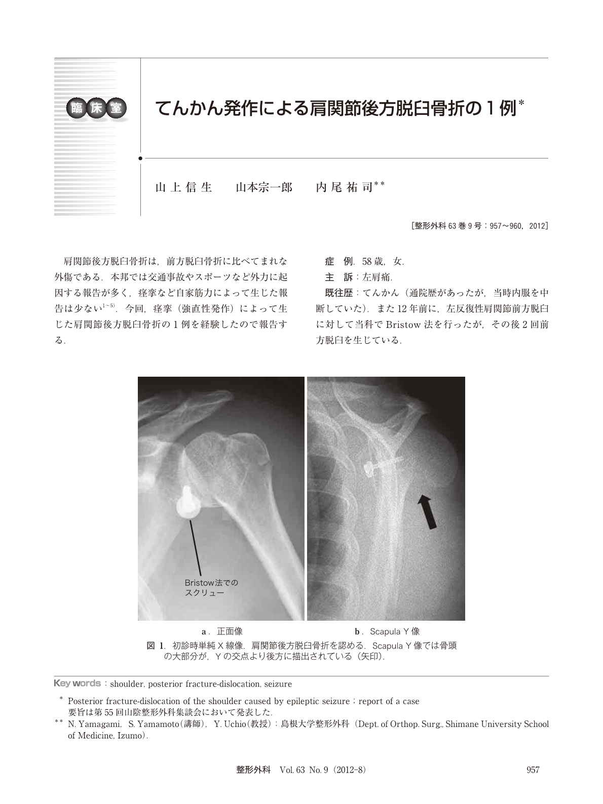 てんかん発作による肩関節後方脱臼骨折の1例 臨床雑誌整形外科 63巻9号 医書 Jp