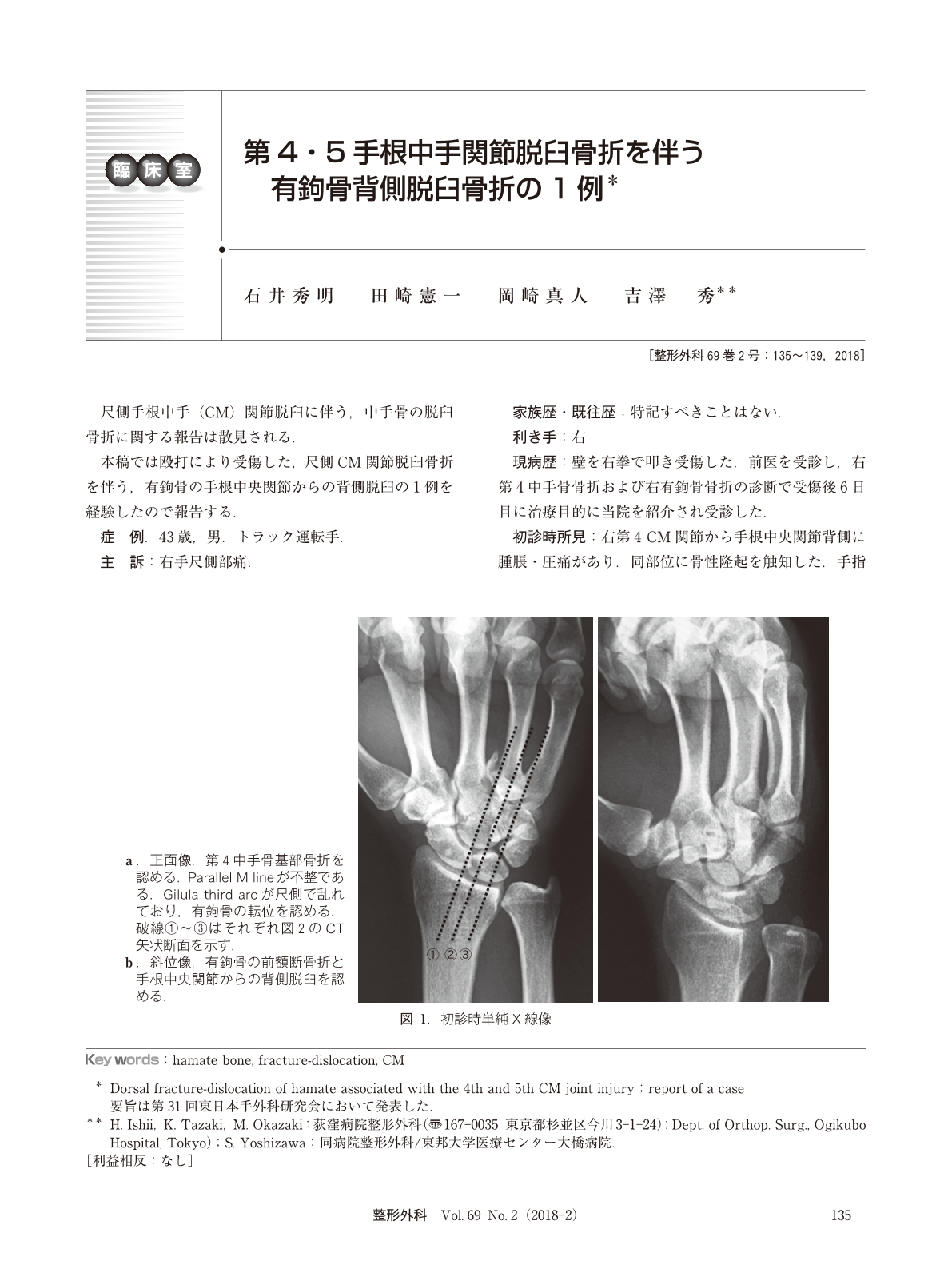 第4・5手根中手関節脱臼骨折を伴う有鉤骨背側脱臼骨折の1例 (臨床雑誌 