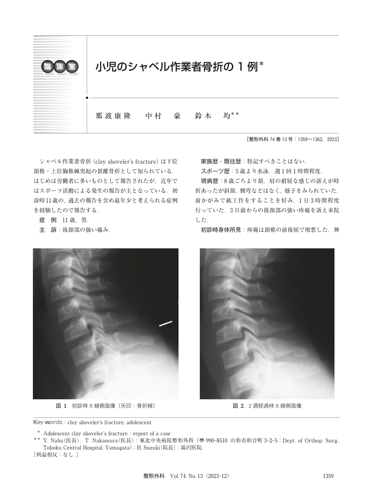 小児のシャベル作業者骨折の1例 (臨床雑誌整形外科 74巻13号) | 医書.jp