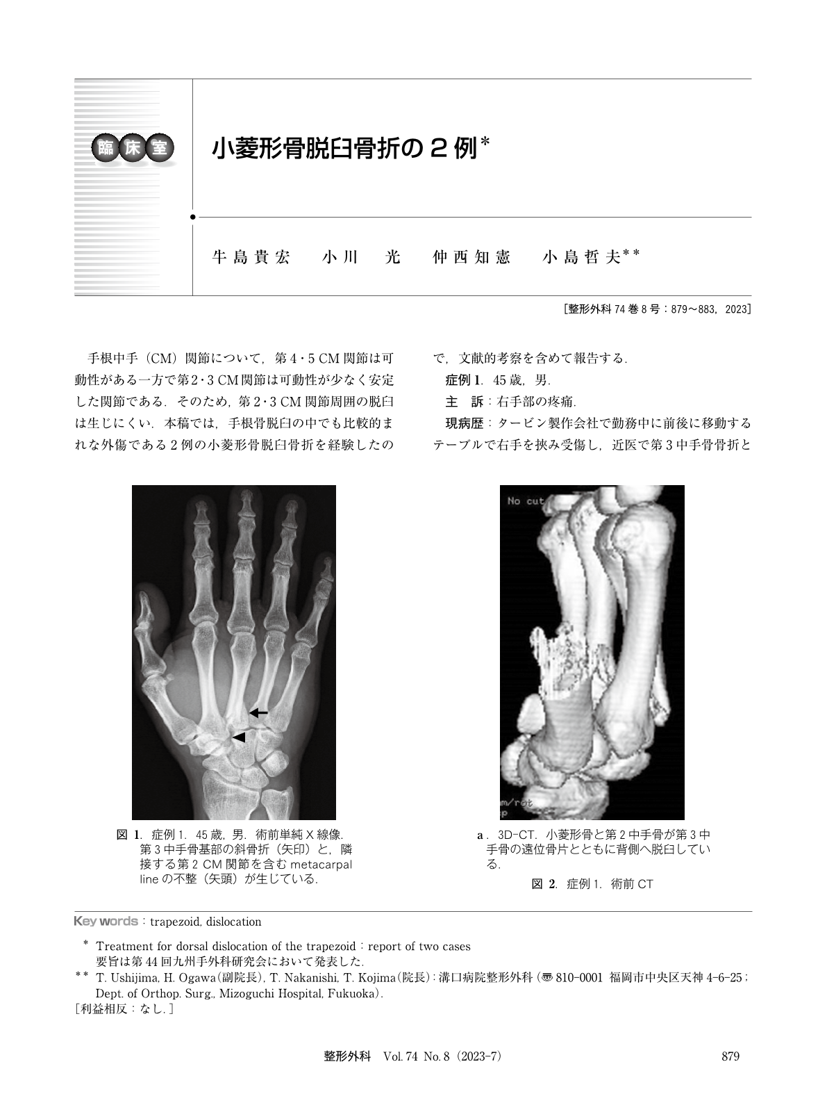 小菱形骨脱臼骨折の2例 (臨床雑誌整形外科 74巻8号) | 医書.jp