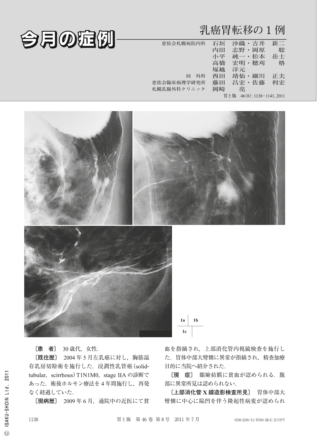 乳癌胃転移の1例 胃と腸 46巻8号 医書 Jp