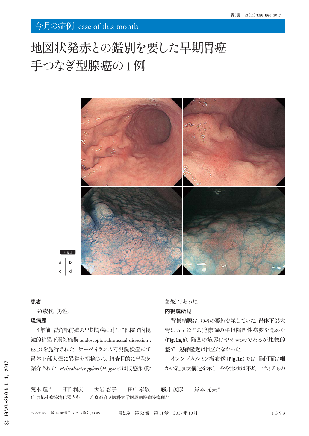 地図状発赤との鑑別を要した早期胃癌手つなぎ型腺癌の1例 胃と腸 52巻11号 医書 Jp