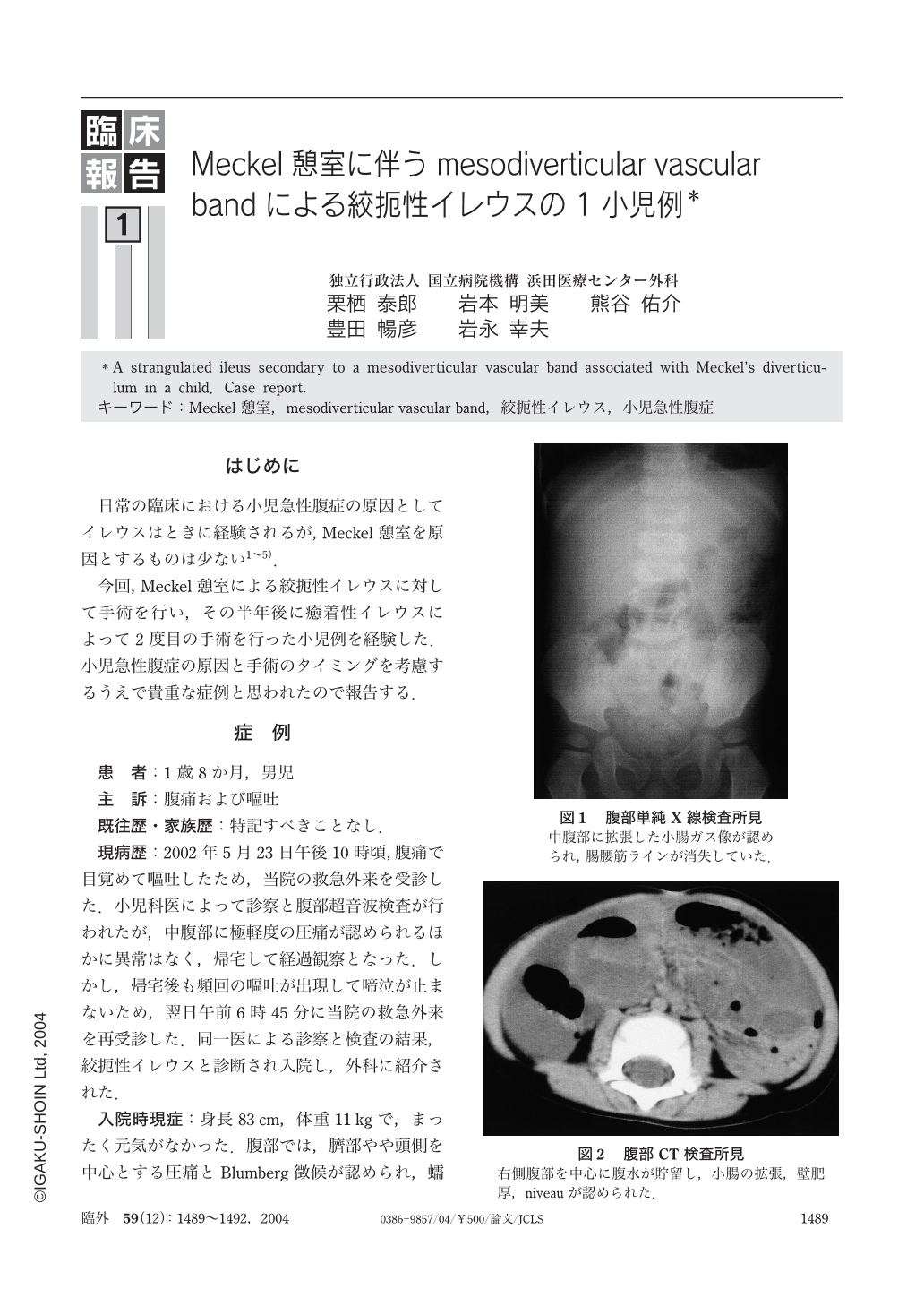 Meckel憩室に伴うmesodiverticular Vascular Bandによる絞扼性イレウスの1小児例 臨床外科 59巻12号 医書 Jp