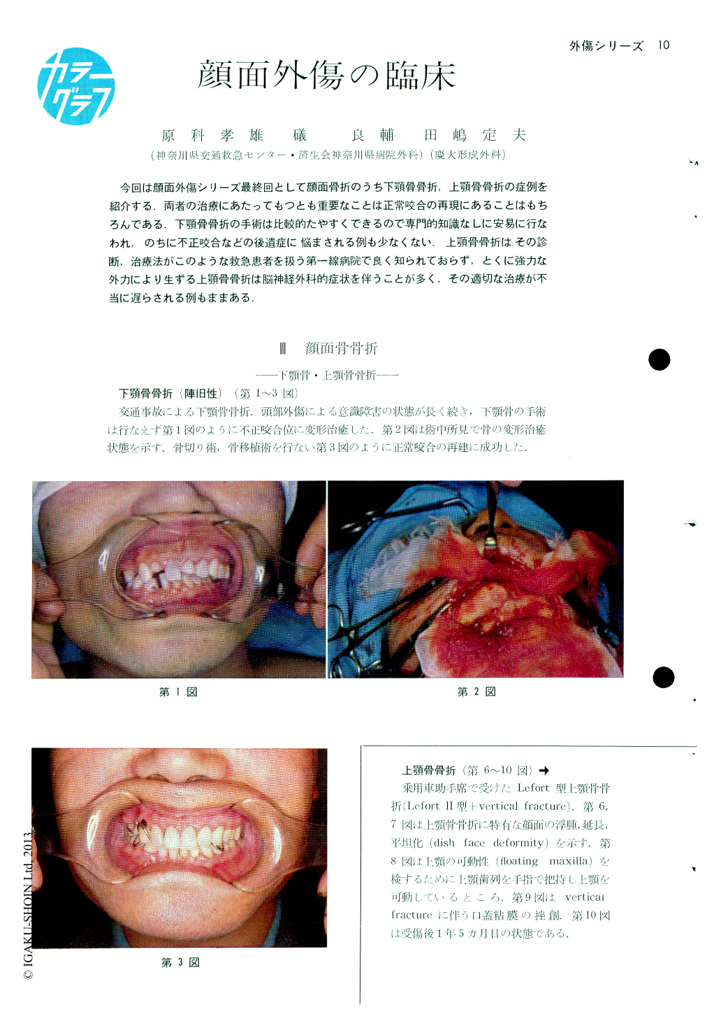 Ⅲ．顔面骨骨折—下顎骨・上顎骨骨折 (臨床外科 26巻10号) | 医書.jp