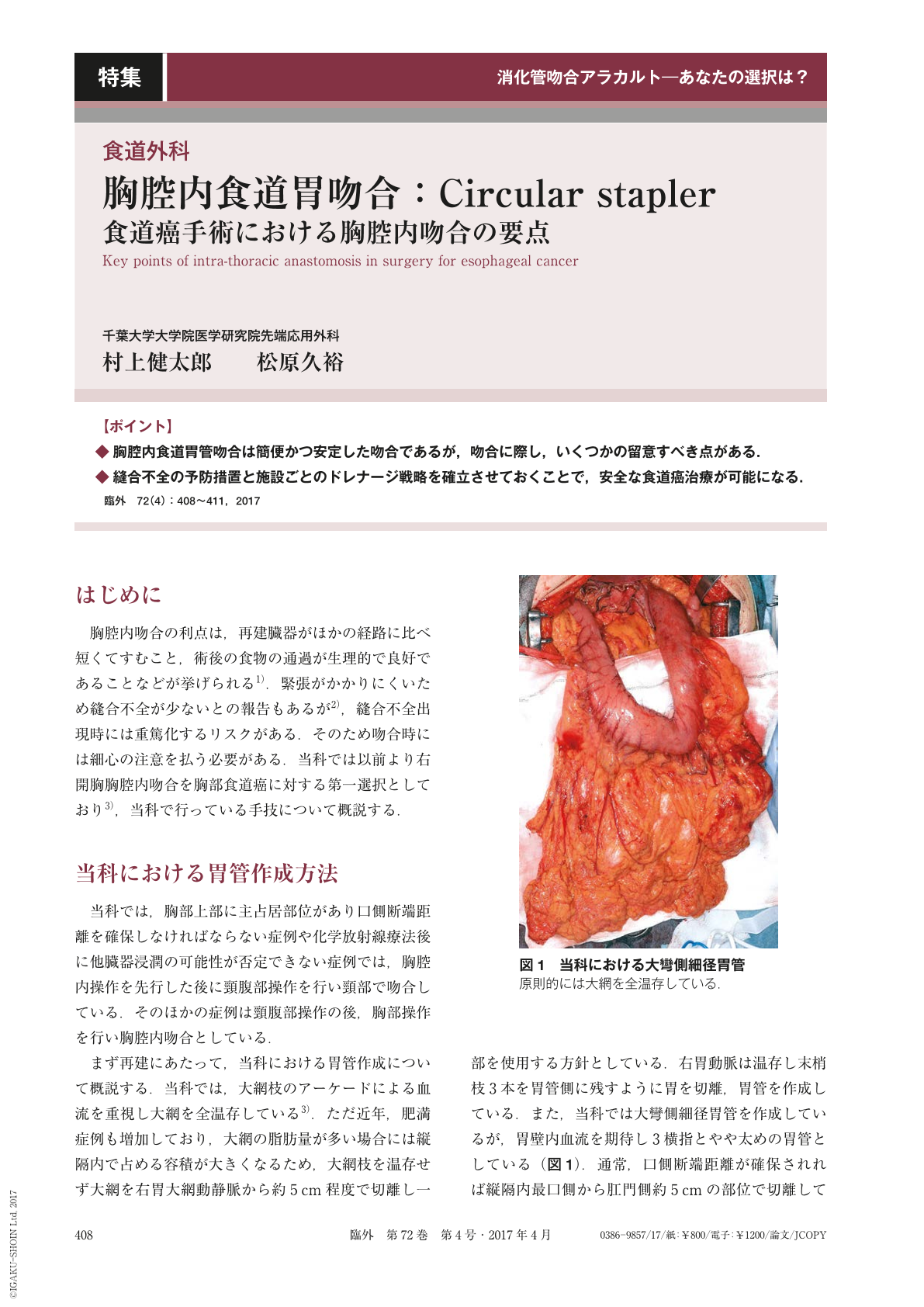 胸腔内食道胃吻合：Circular stapler—食道癌手術における胸腔内吻合の 