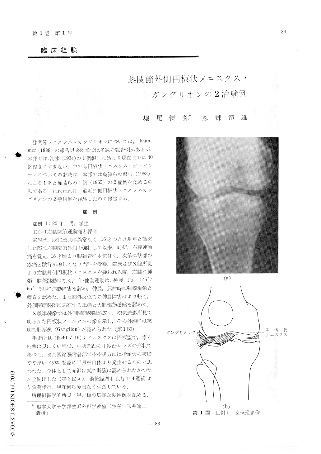 膝関節外側円板状メニスクス ガングリオンの2治験例 臨床整形外科 1巻1号 医書 Jp