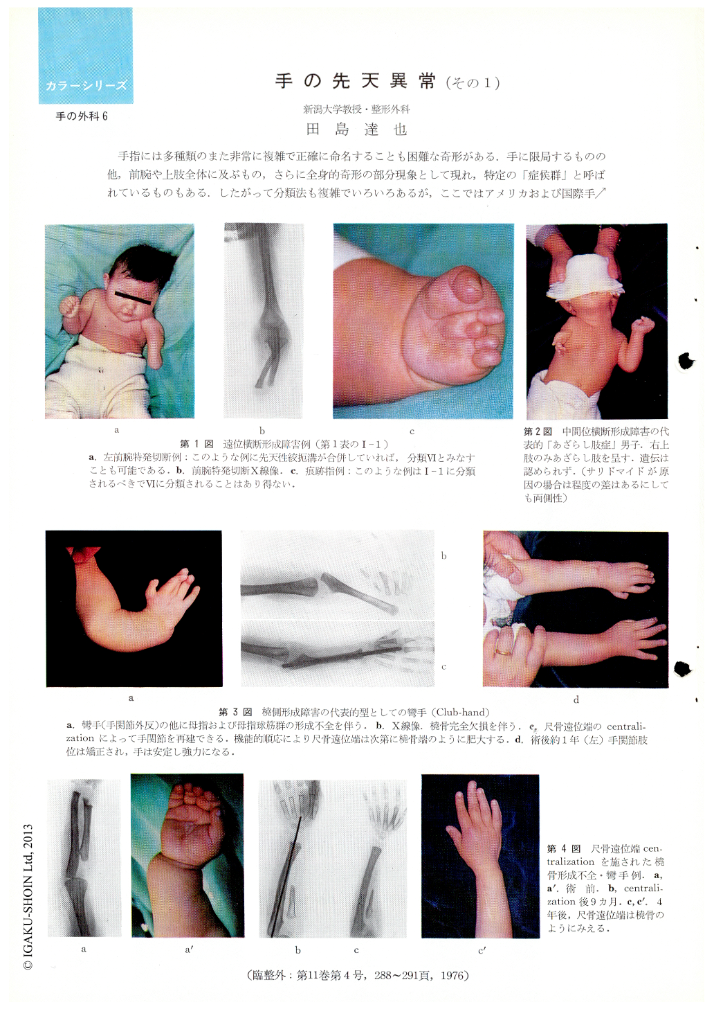 手の先天異常（その1） (臨床整形外科 11巻4号) | 医書.jp