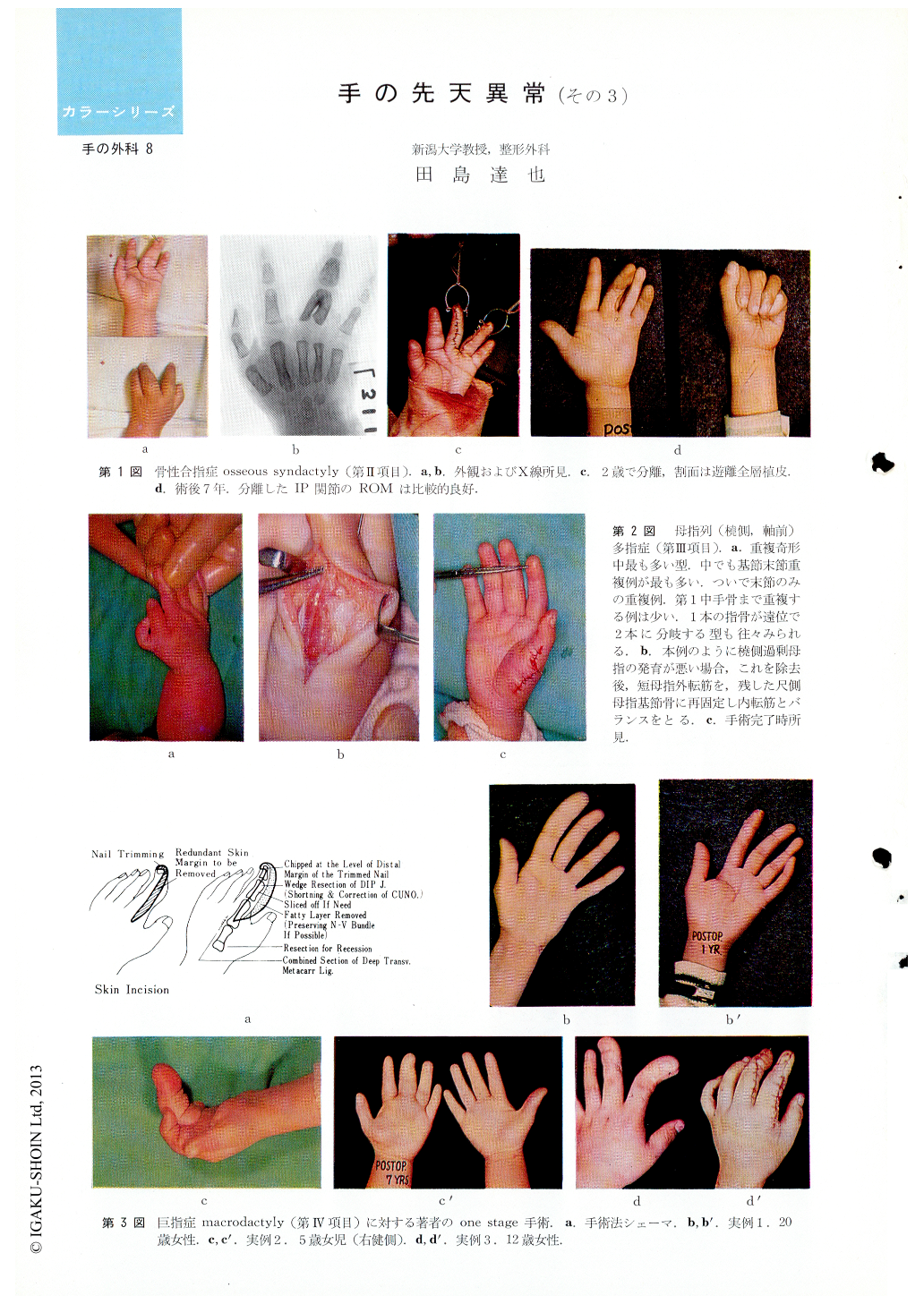手の先天異常（その3） (臨床整形外科 11巻6号) | 医書.jp
