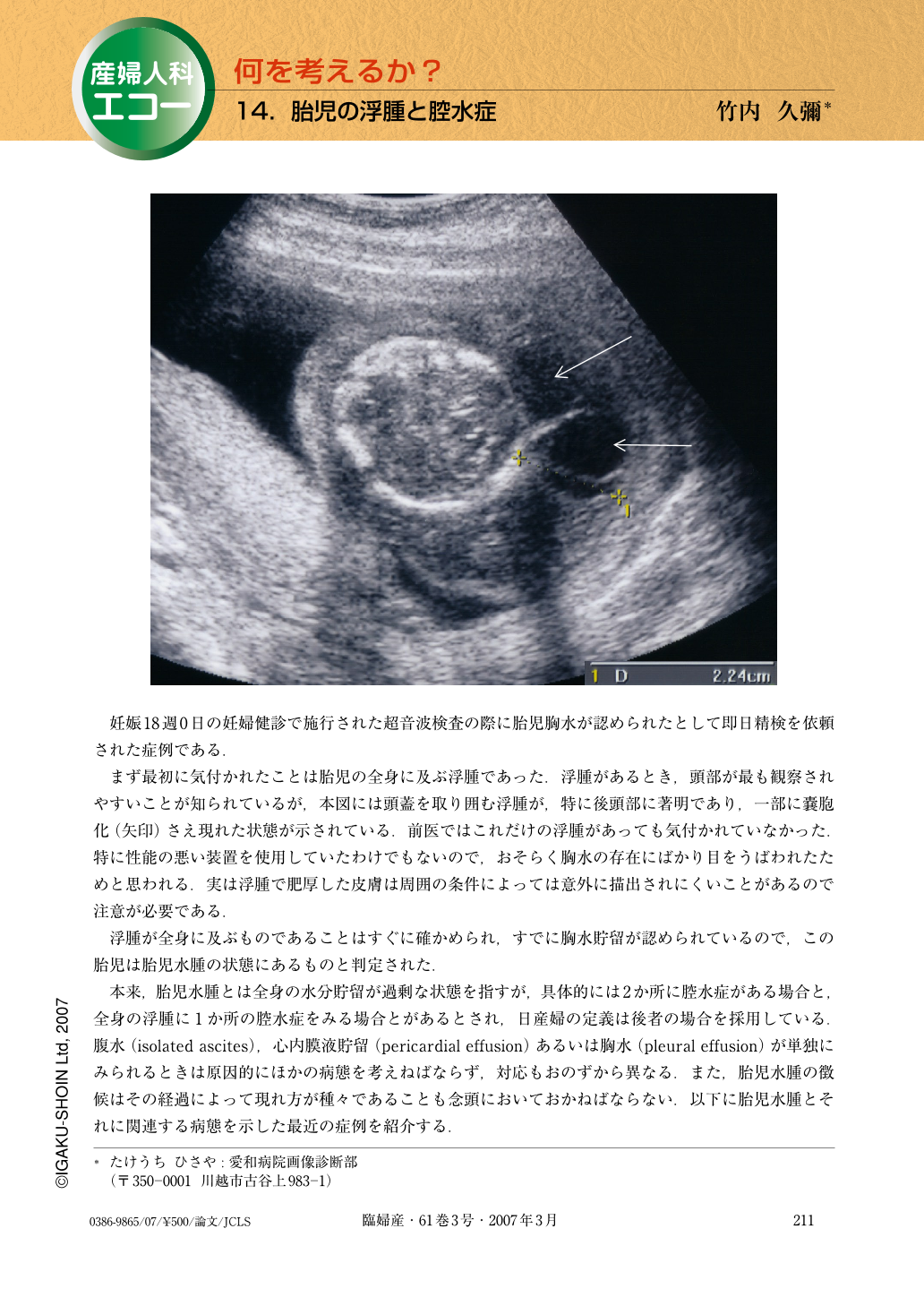 胎児の浮腫と腔水症 臨床婦人科産科 61巻3号 医書 Jp