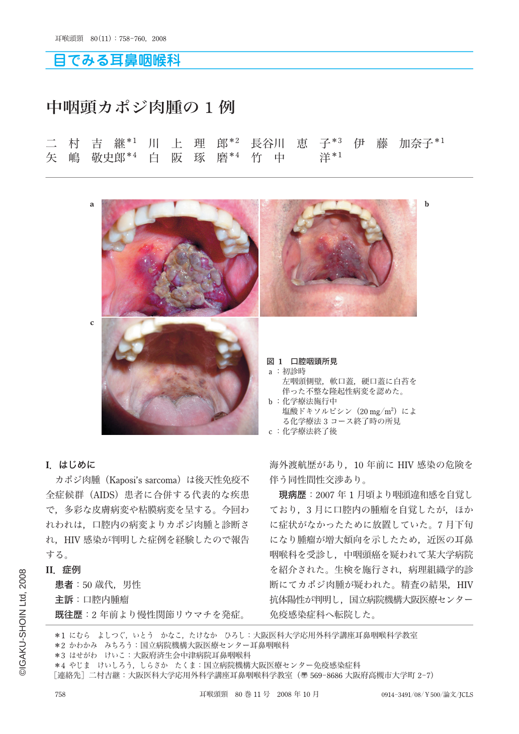 中咽頭カポジ肉腫の1例 耳鼻咽喉科 頭頸部外科 80巻11号 医書 Jp