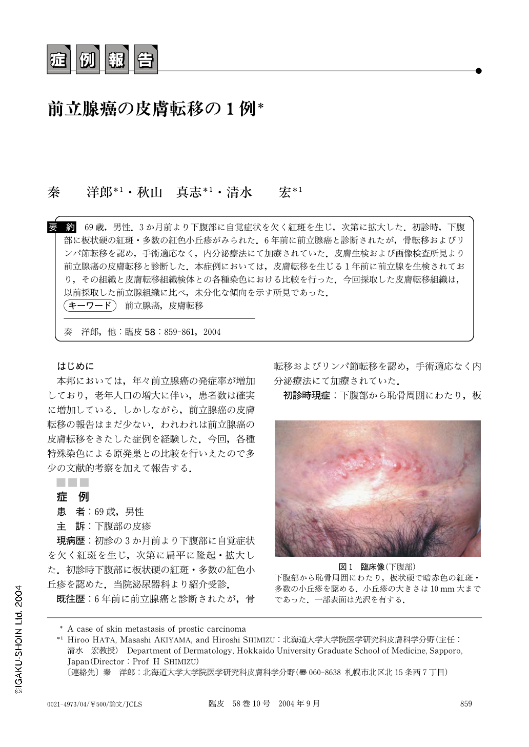 前立腺癌の皮膚転移の1例 臨床皮膚科 58巻10号 医書 Jp