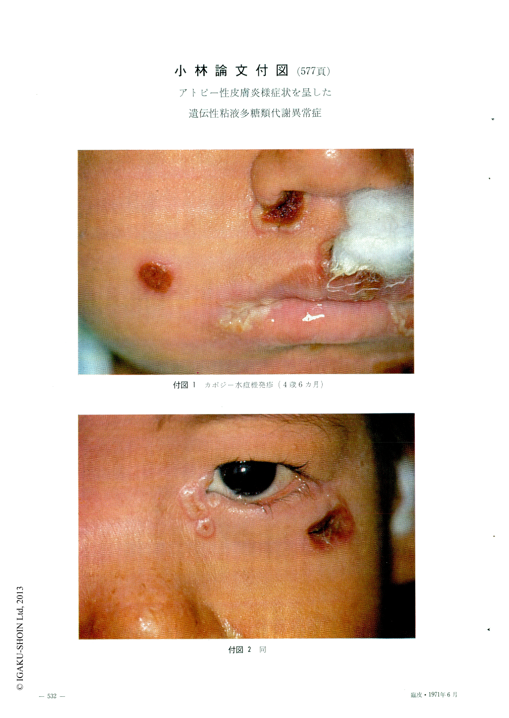 アトピー性皮膚炎様症状を呈した遺伝性粘液多糖類代謝異常症 臨床皮膚科 25巻6号 医書 Jp