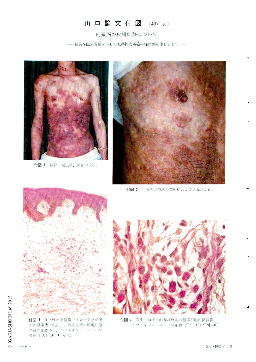 内臓癌の皮膚転移について 特異な臨床所見を呈した転移性皮膚癌の経験例を中心として 臨床皮膚科 26巻6号 医書 Jp