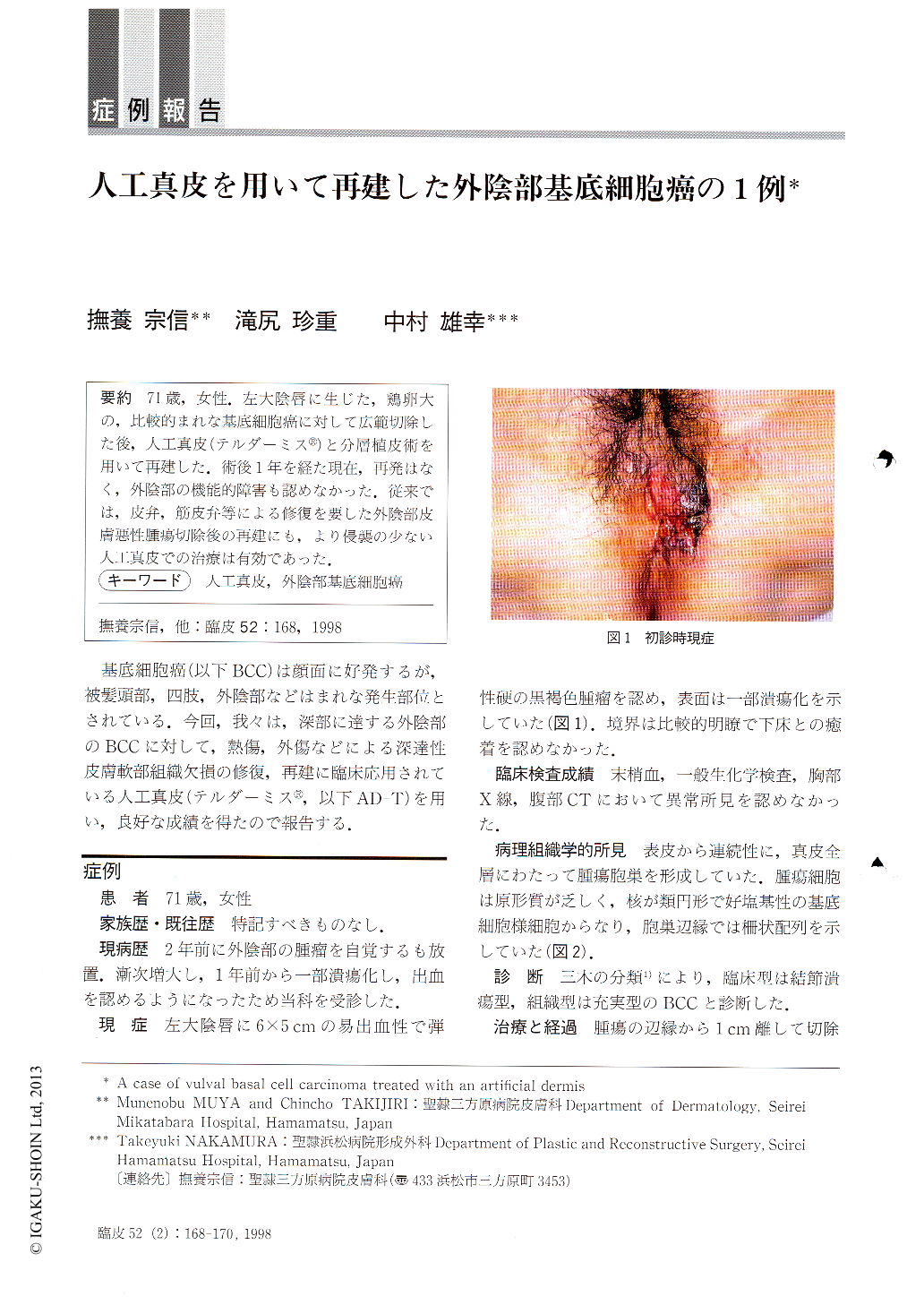 人工真皮を用いて再建した外陰部基底細胞癌の1例 臨床皮膚科 52巻2号 医書 Jp
