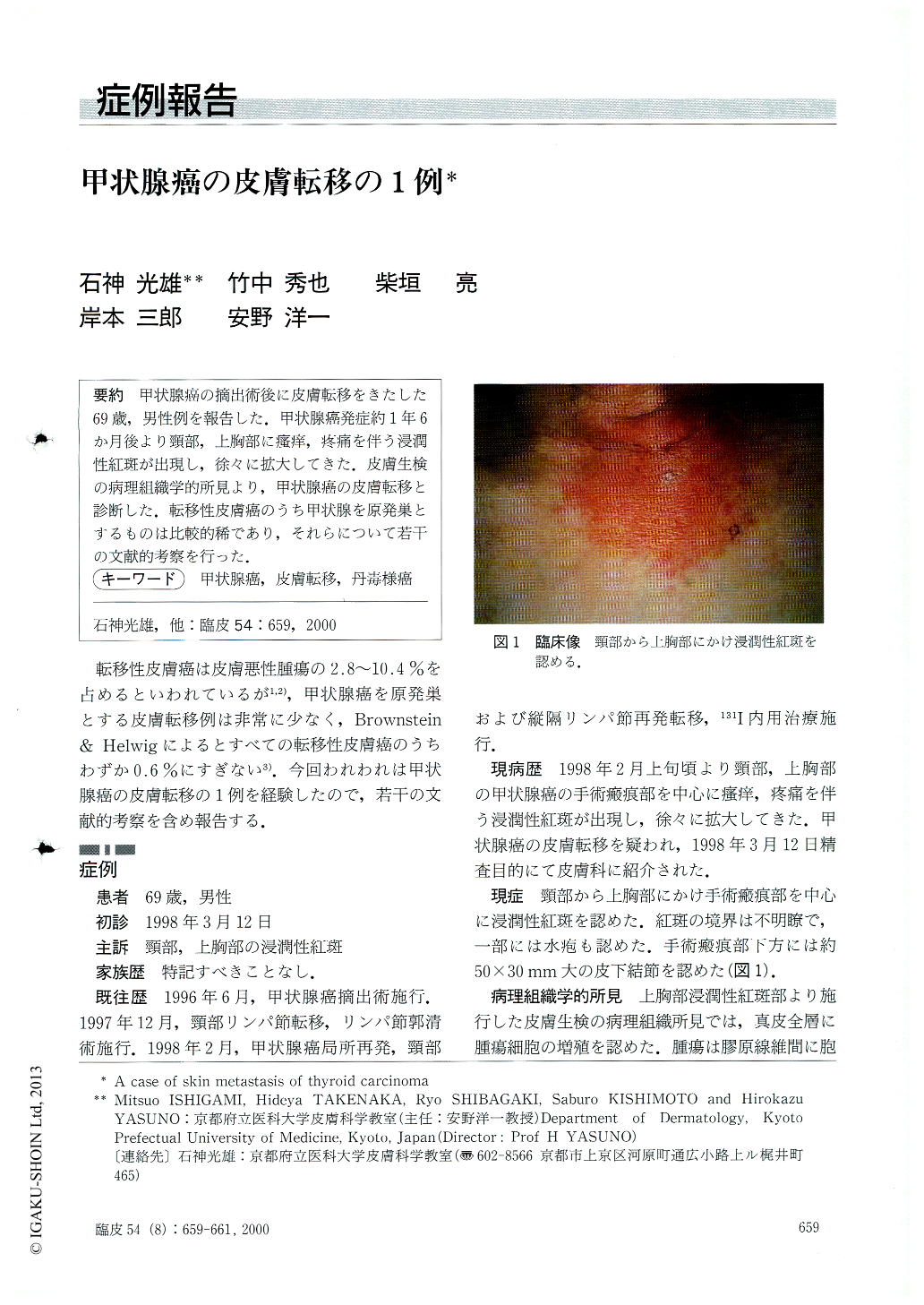 甲状腺癌の皮膚転移の1例 臨床皮膚科 54巻8号 医書 Jp