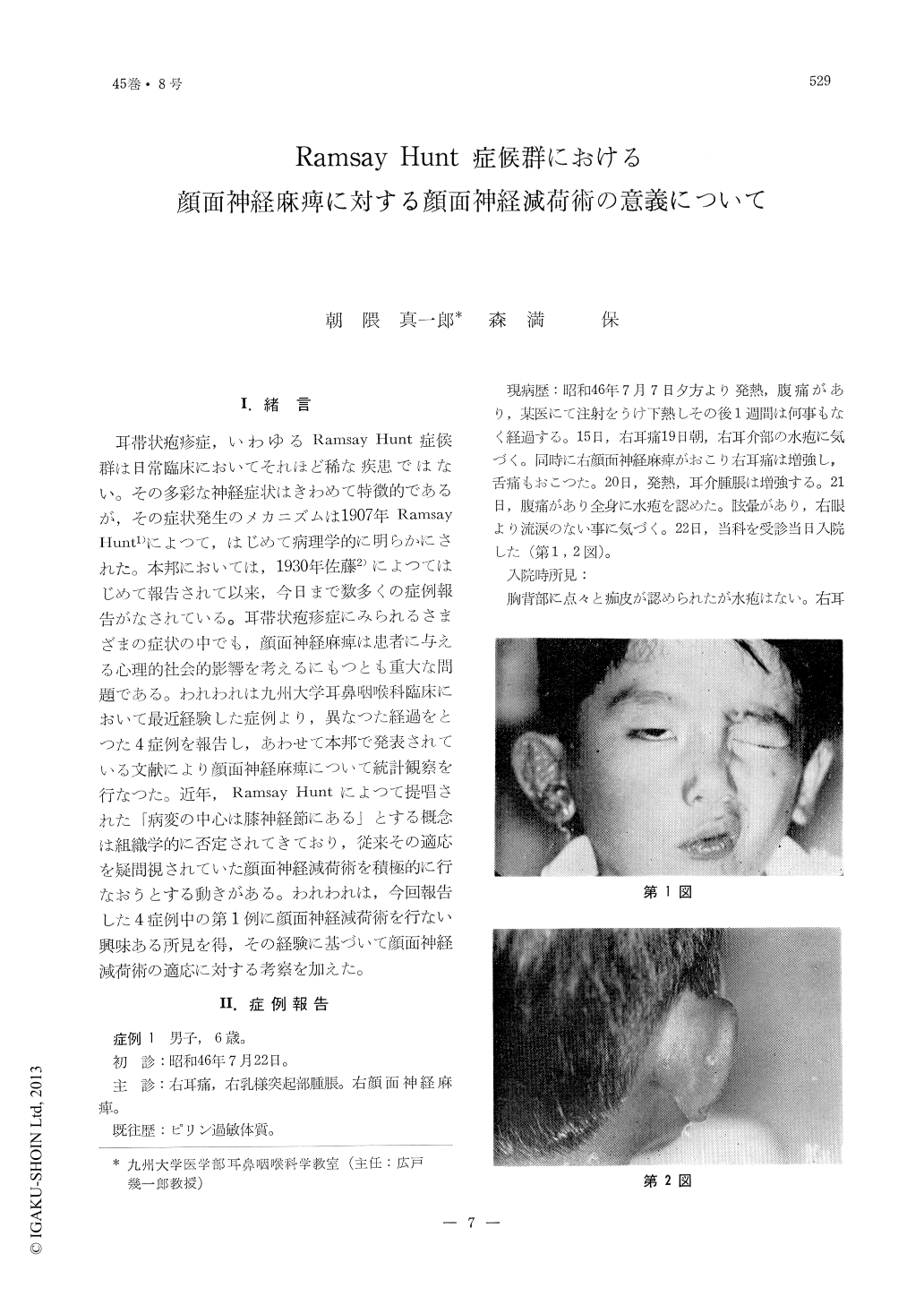 Ramsay Hunt症候群における顔面神経麻痺に対する顔面神経減荷術の意義 