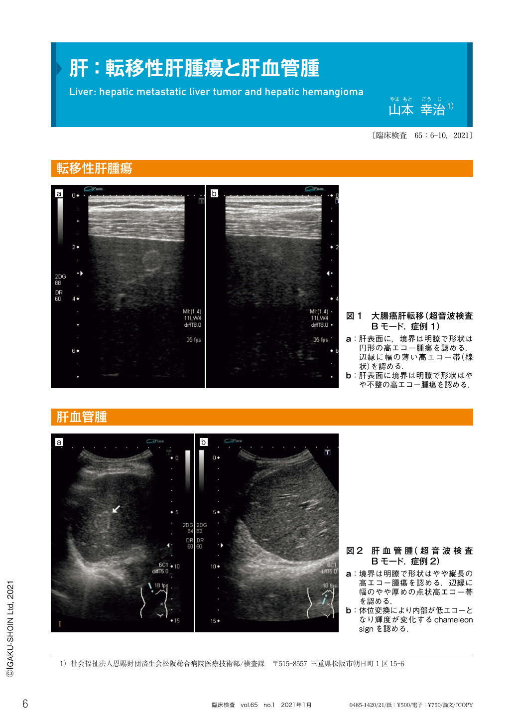 肝 転移性肝腫瘍と肝血管腫 臨床検査 65巻1号 医書 Jp